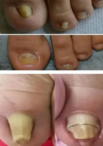 tratamento unha deformada