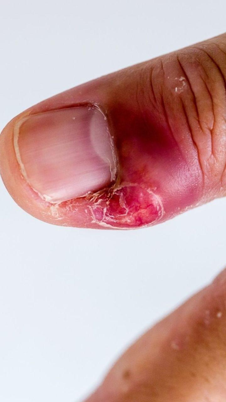 Paroníquia Aguda vs. Crônica: Entenda as Diferenças e Tratamentos