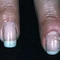Prevenção de Paroníquia: Dicas para Manter suas Unhas Saudáveis