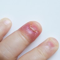 Como Tratar o Unheiro em Casa: Remédios e Cuidados Essenciais