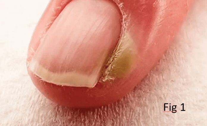 5 dicas para evitar unheiro e ter unhas saudáveis