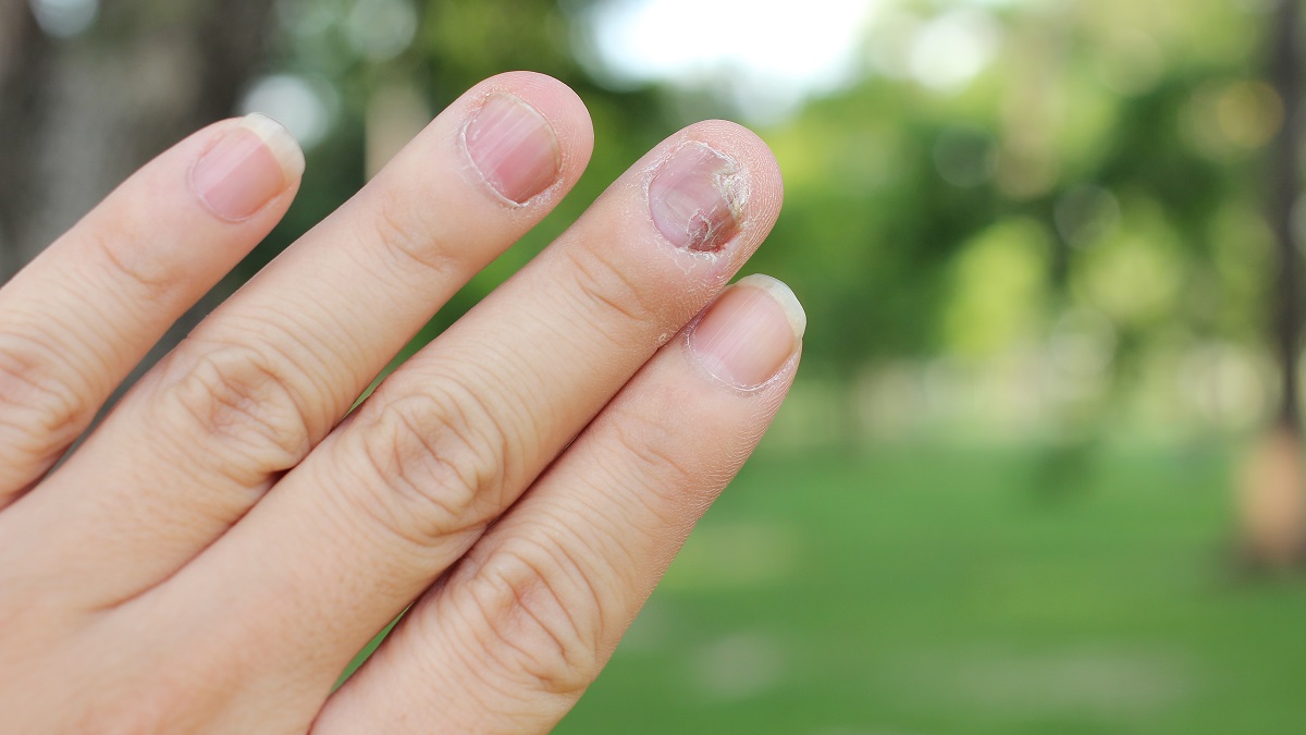 risco preto na unha do polegar