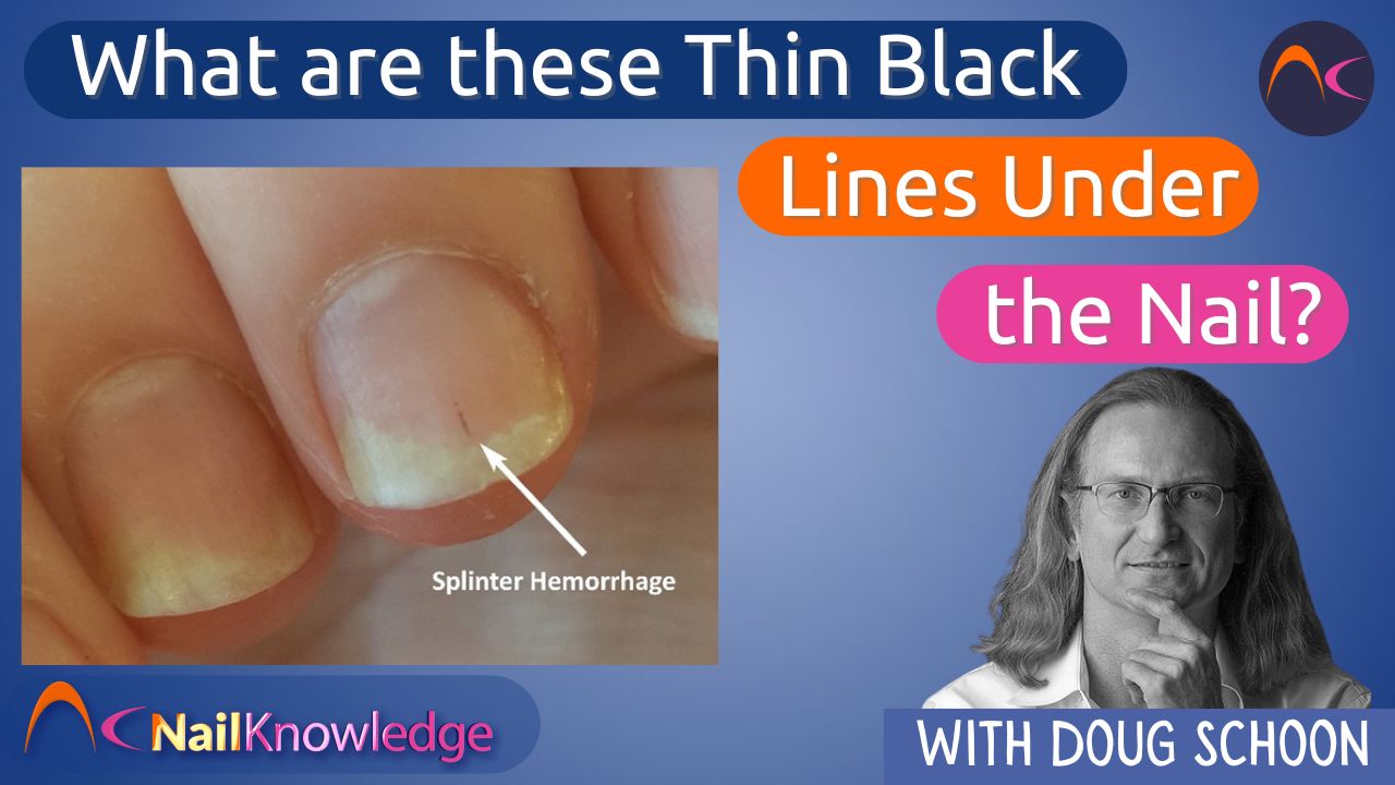 melanoma de unha sintomas