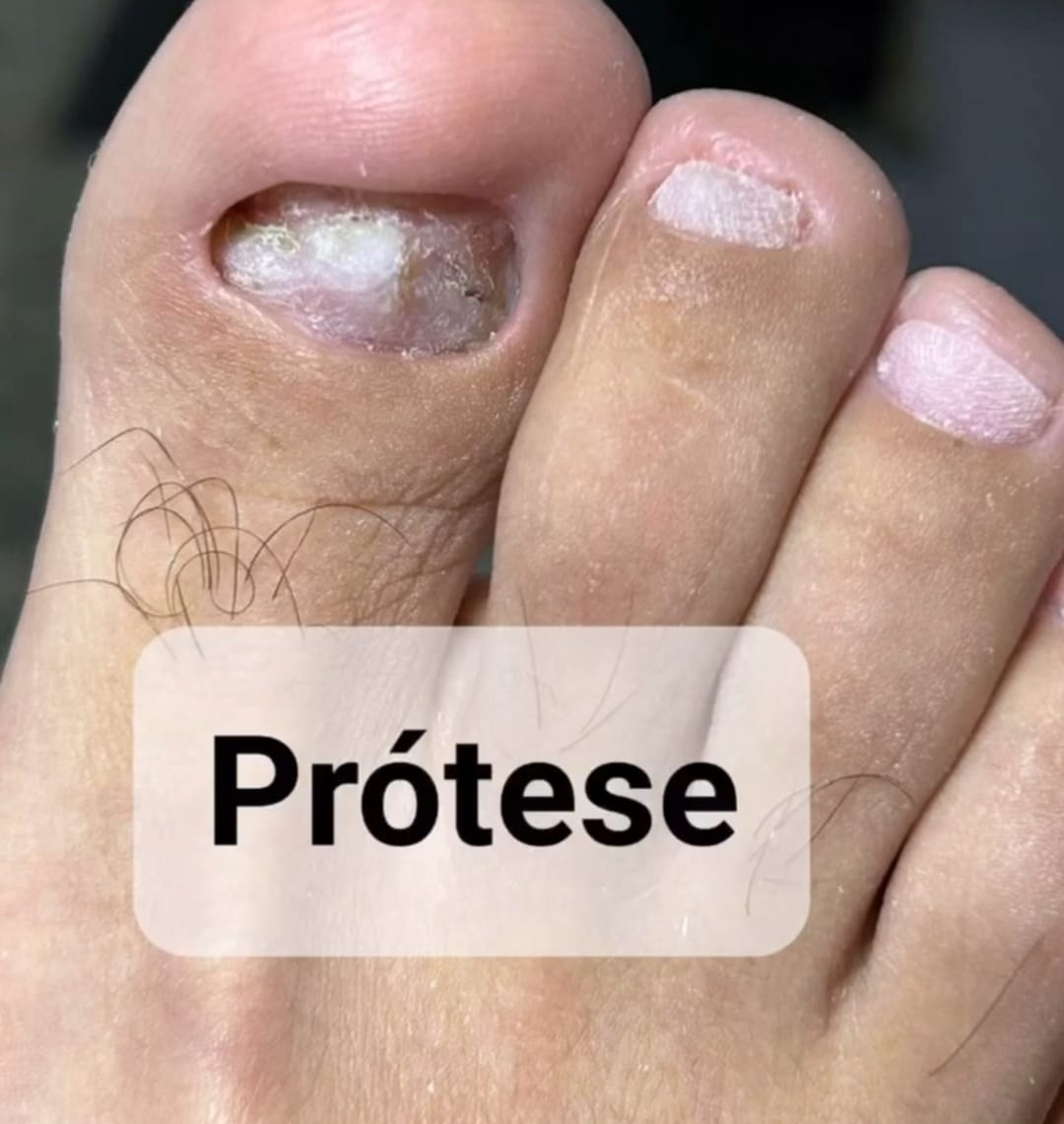alongamento de unhas antes de cirurgia