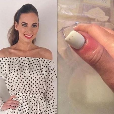 alongamento de unhas antes de cirurgia