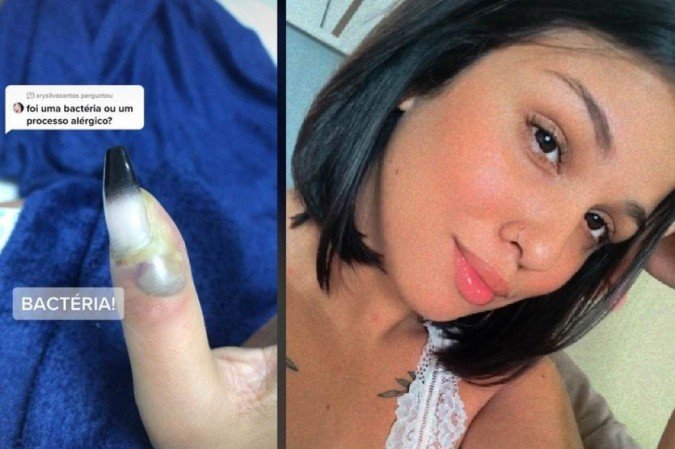 alongamento de unhas antes de cirurgia