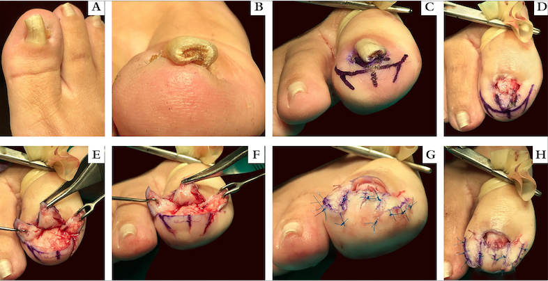 monitoramento de oxigênio unhas de gel
