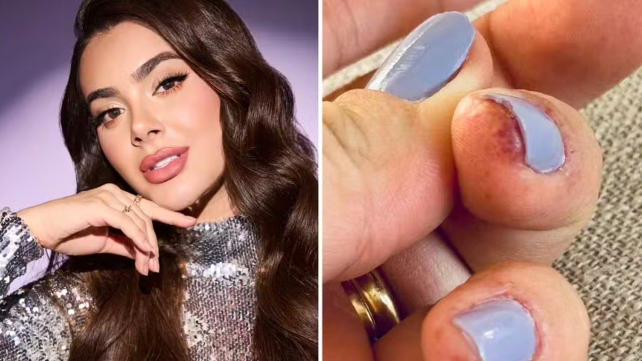 Como identificar e tratar a dermatite de contato causada por unhas de gel