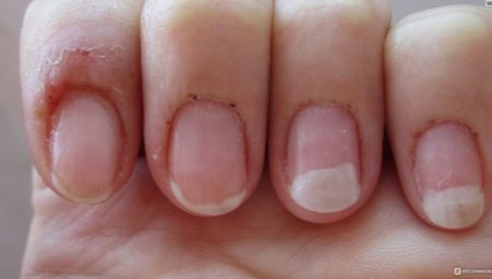 Alternativas seguras: Géis e esmaltes hipoalergênicos para unhas de gel