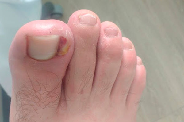 granuloma na unha tratamento