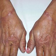betametasona para granuloma