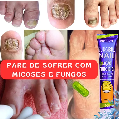 betametasona para granuloma