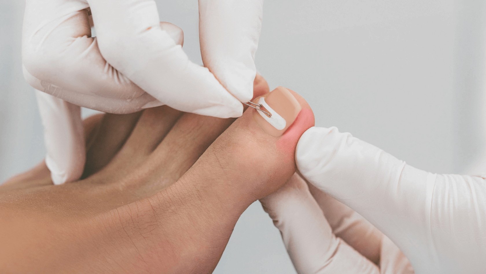 mupirocina para granuloma unha