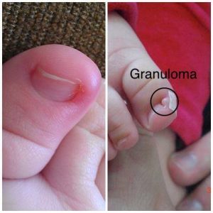 Quando a unha encravada do bebê precisa de atenção médica?