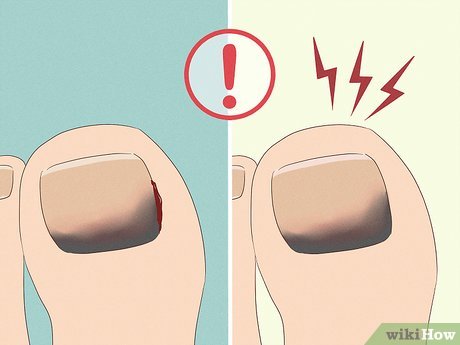 hematoma subungueal