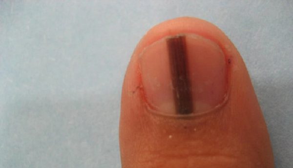 unha da mão com risco preto