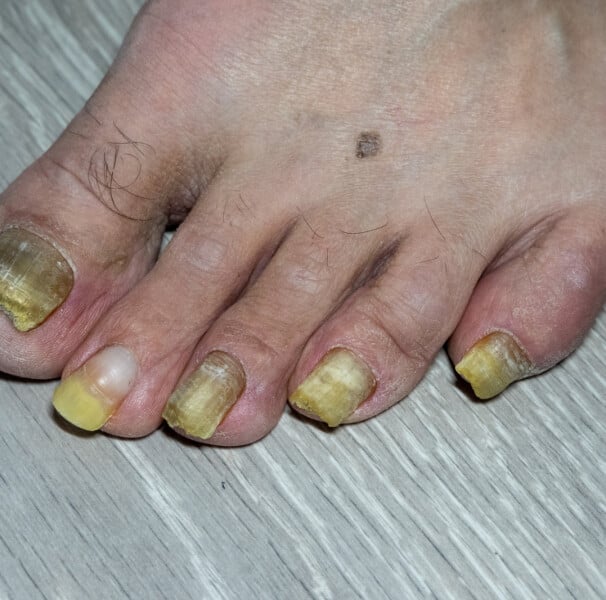 erros comuns ao tratar micose de unha amarela