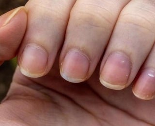 unha amarela vs unha com fungo qual a diferença