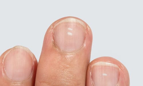 o que fazer quando a unha fica branca por trauma