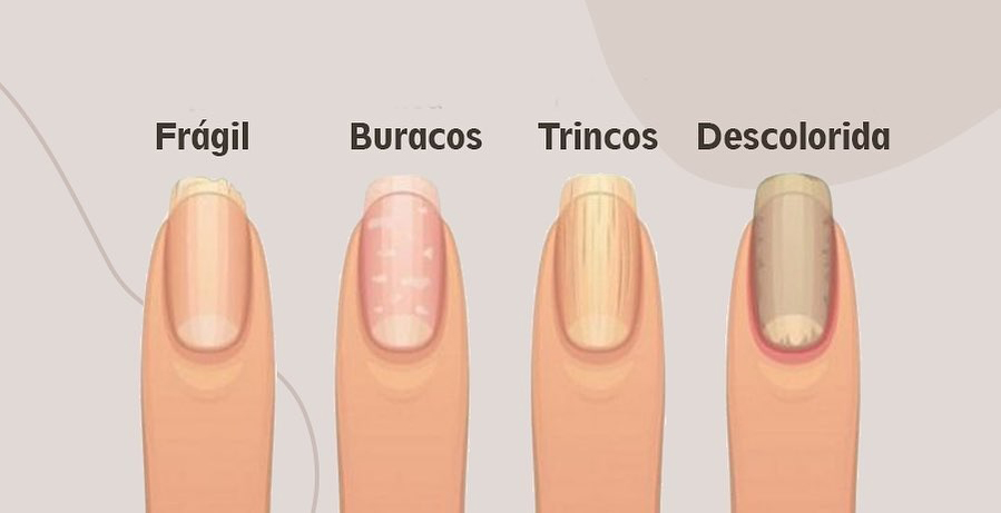 5 ideias de títulos:
1. Psoríase Ungueal: Guia Completo de Sintomas e Tratamentos
2. Como Identificar e Tratar a Psoríase nas Unhas: Dicas de Especialistas
3. Psoríase Ungueal vs. Micose: Entenda as Diferenças Cruciais
4. Artrite Psoriásica e Unhas: A Conexão que Você Precisa Saber
5. Cuidados Essenciais para Unhas com Psoríase: Prevenção e Manejo