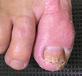 5 dicas para aliviar psoríase na unha do pé