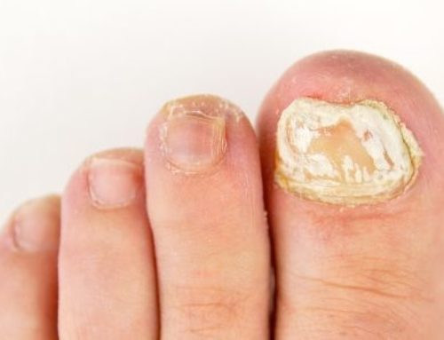 erros comuns no tratamento da psoríase na unha do pé
