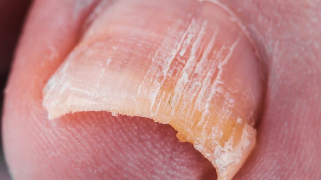 Tratamentos Eficazes para Psoríase Ungueal: Opções Tópicas e Sistêmicas