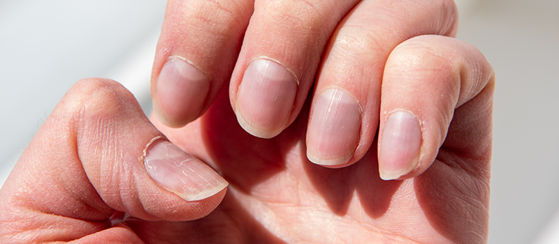 psoríase na unha fotos