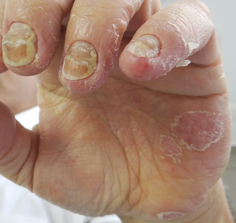Psoríase Ungueal: Guia Completo de Sintomas e Como Identificar