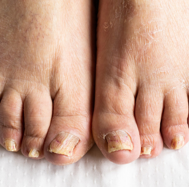 Psoríase vs. Micose na Unha: Entenda as Diferenças Cruciais