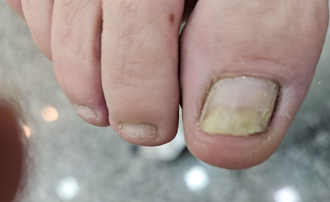 Tratamentos Eficazes para Psoríase Ungueal: Opções Tópicas e Sistêmicas