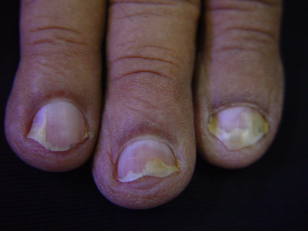 psoríase na unha fotos