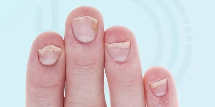 Tratamentos Eficazes para Psoríase Ungueal: Opções Tópicas e Sistêmicas