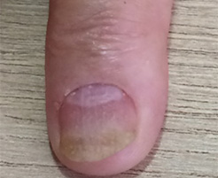 Psoríase Ungueal: Guia Completo de Sintomas e Como Identificar