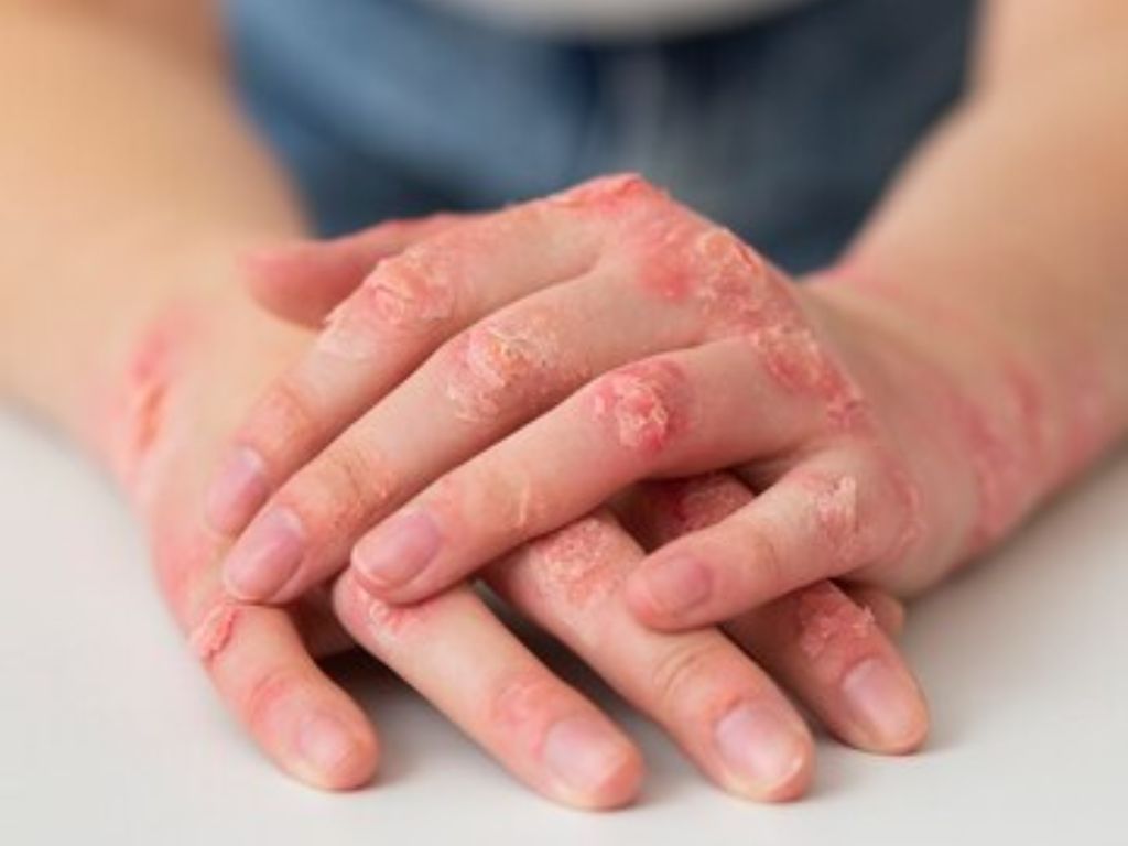 Psoríase vs. Micose na Unha: Entenda as Diferenças Cruciais