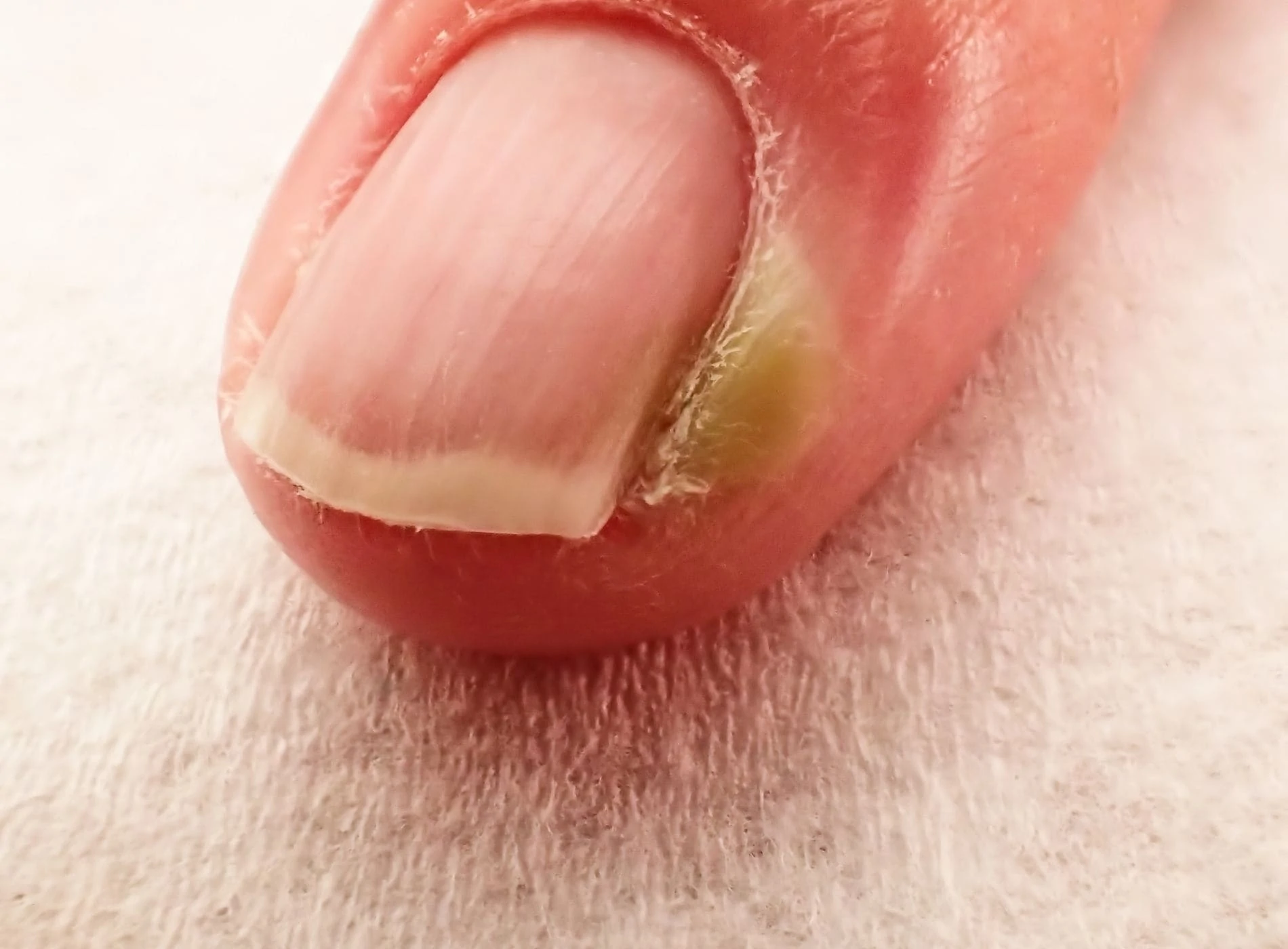 erros comuns ao tratar pus sob a unha