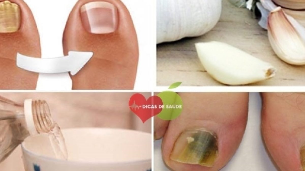 5 ideias de títulos:
1. Micose de Unha: Guia Completo de Tratamentos Caseiros e Médicos
2. Os Melhores Remédios Naturais para Combater Fungos nas Unhas
3. Quando Procurar um Dermatologista para Micose de Unha?
4. Vinagre de Maçã vs. Óleo de Melaleuca: Qual o Melhor para Fungos?
5. Dicas Essenciais para Prevenir a Recorrência de Micose de Unha