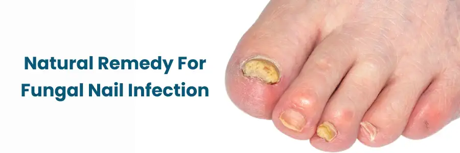 remédio caseiro para fungos na unha do pé