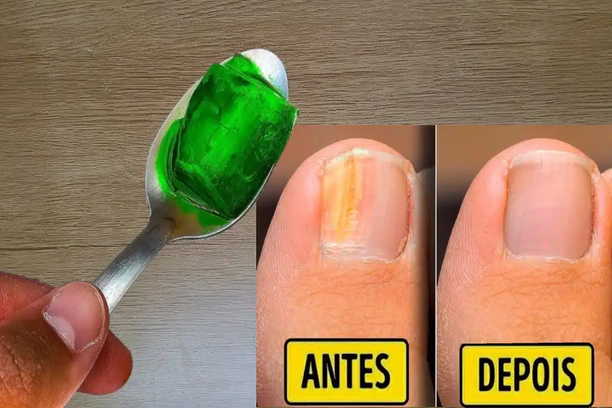 Escalda-pés para Micose: Receitas com Vinagre e Bicarbonato