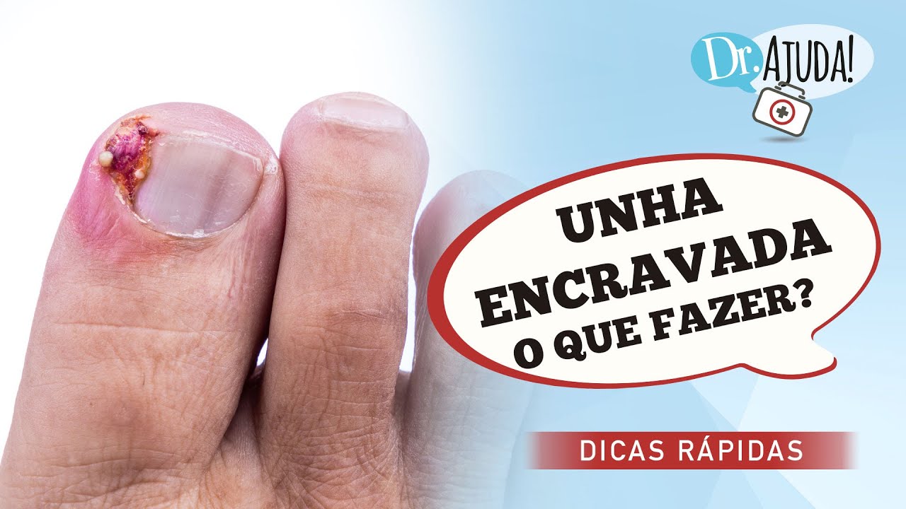 Guia Completo: Como Cortar as Unhas Corretamente para Evitar Inflamação