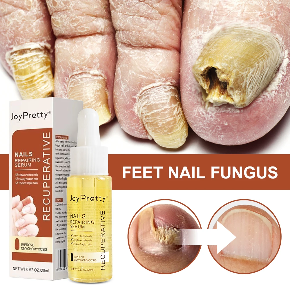 Guia Completo: Como Tratar Fungos nas Unhas com Esmaltes Terapêuticos