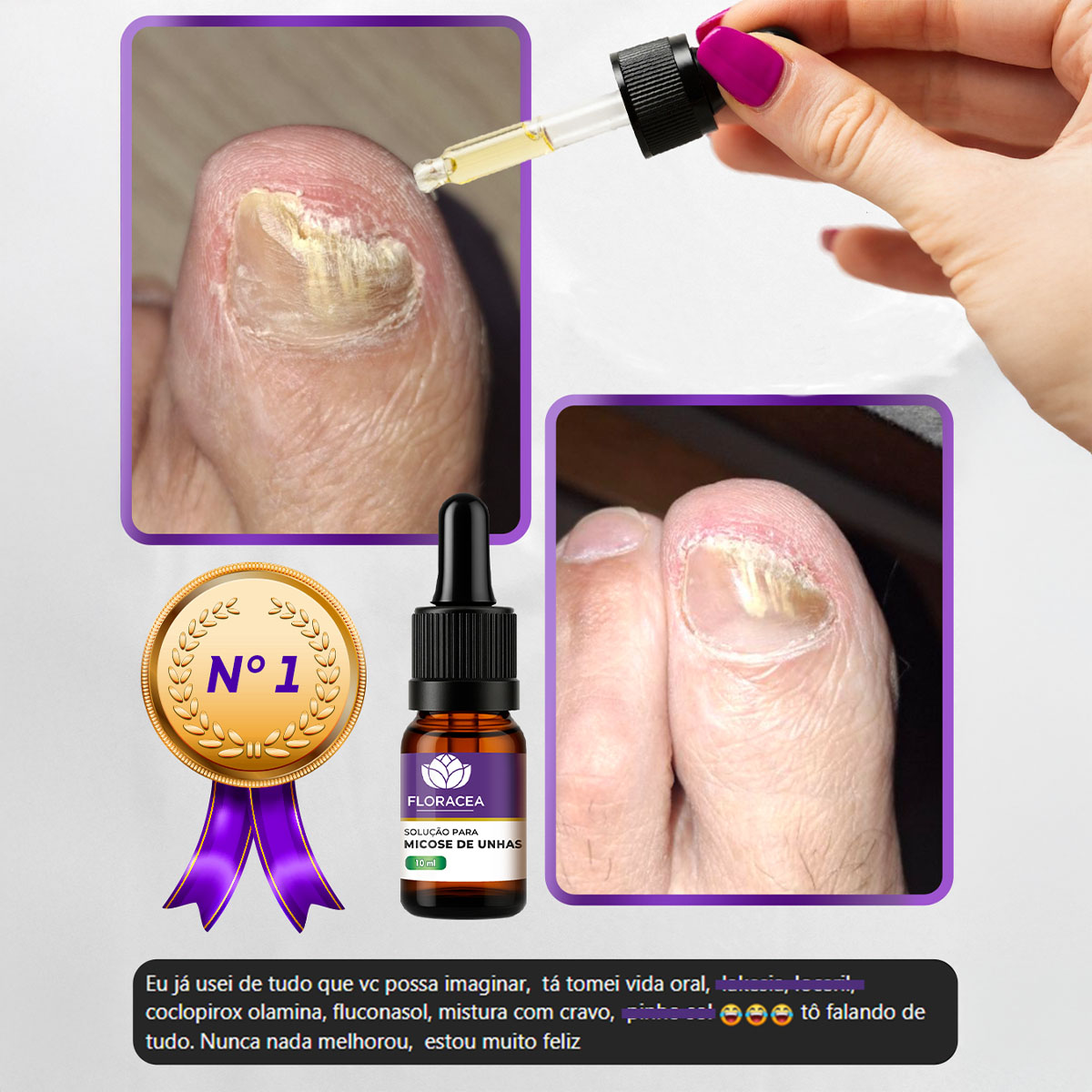 remedio micose unha