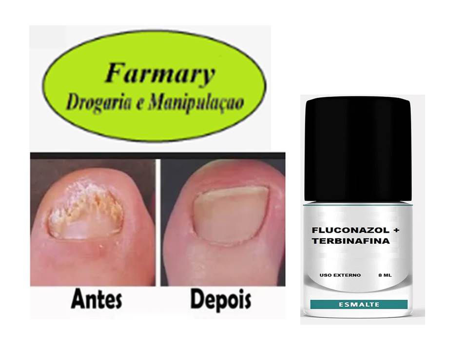 5 ideias de títulos:
1. Onicomicose: Guia Completo de Tratamentos e Cuidados.
2. Fungos nas Unhas: Opções Tópicas e Orais para Combater a Infecção.
3. Remédios Caseiros para Micose de Unha: Eficácia e Precauções.
4. Dermatologista e Micose: A Importância da Orientação Profissional.
5. Prevenção e Tratamento da Onicomicose: Dicas Essenciais.