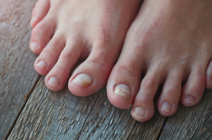 remedio para fungos na unha do pé