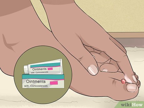 granuloma na unha tratamento