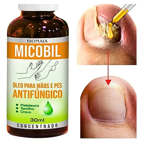 1. O que é a Onicomicose e Como Tratá-la com Antifúngicos Orais
2. Terbinafina vs. Fluconazol: Qual o Melhor Antifúngico para Micose de Unha?
3. Itraconazol em Pulsoterapia: Uma Opção Eficaz para Micoses Resistentes
4. Cuidados Essenciais Durante o Tratamento Oral para Micose de Unha
5. Quando os Tratamentos Tópicos Falham: A Necessidade de Antifúngicos Sistêmicos