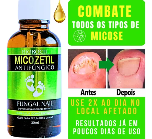 Guia Completo dos Medicamentos para Micose de Unha: Qual Escolher?