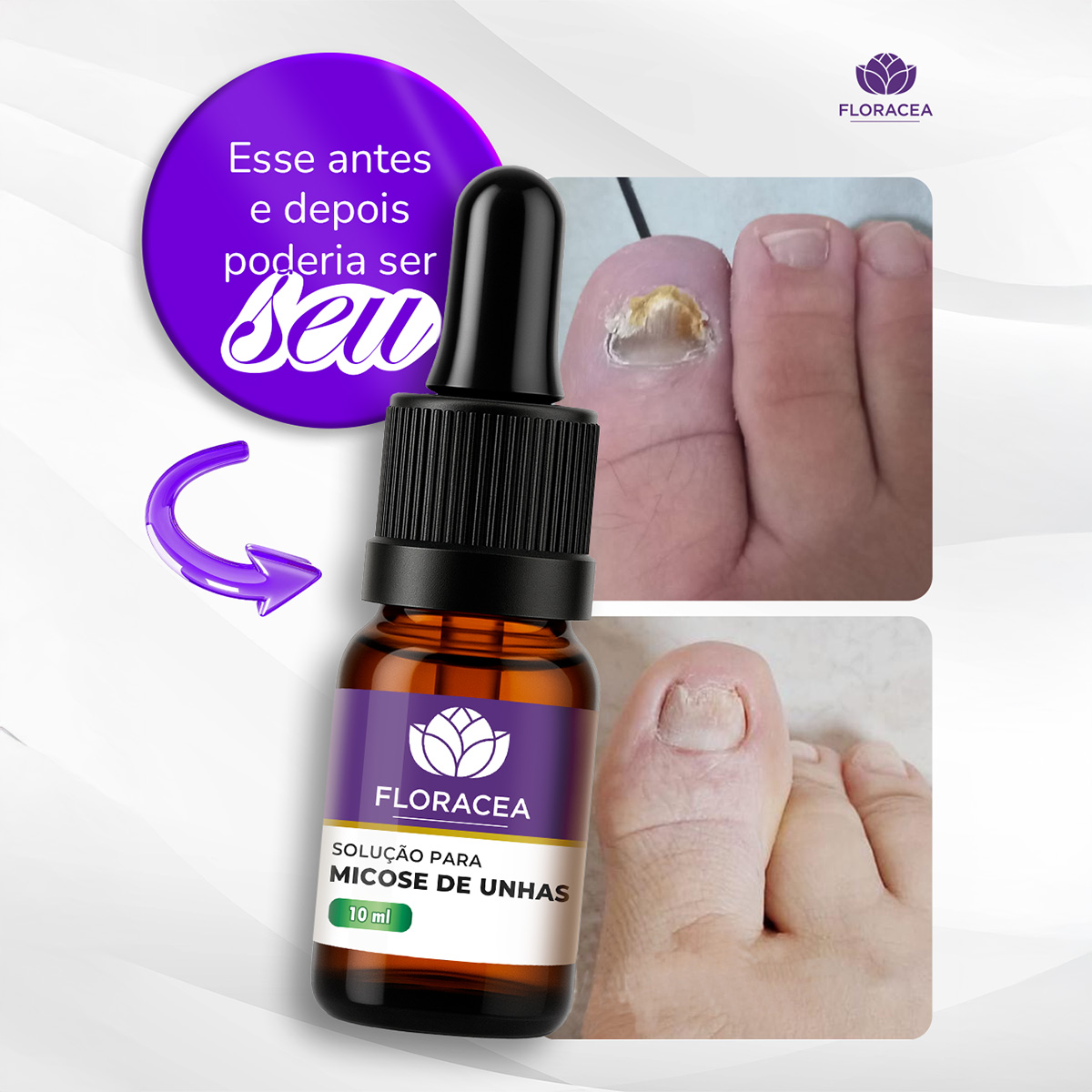 onde comprar remédio micose unha gotas
