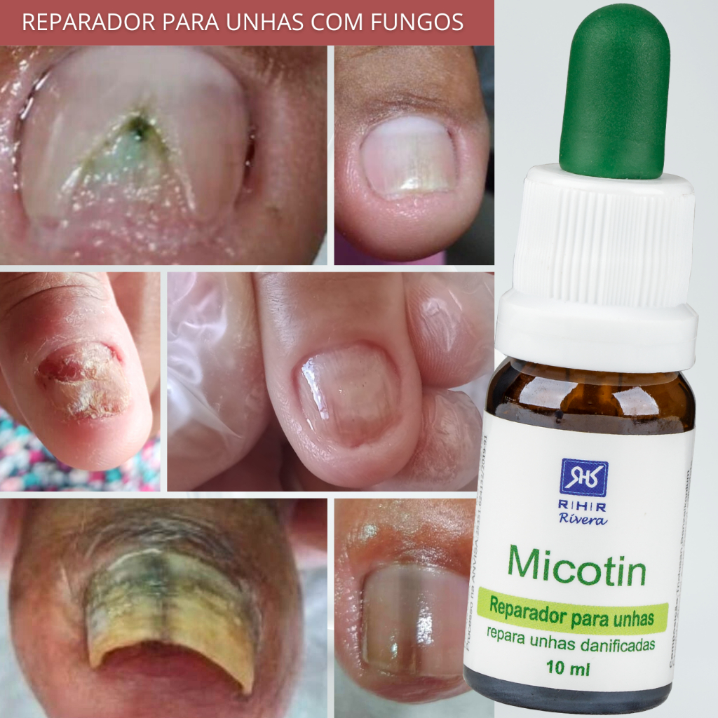 clotrimazol gotas unha
