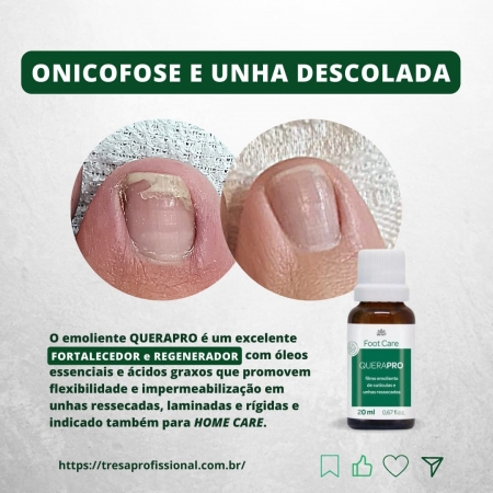 Micose de Unha: Como Identificar e Tratar Corretamente